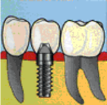 A fogászati implantációról...